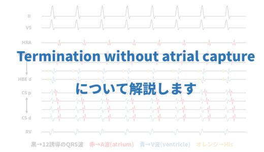 Termination without atrial captureについて解説します。